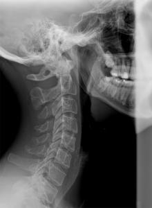 neck-x-ray